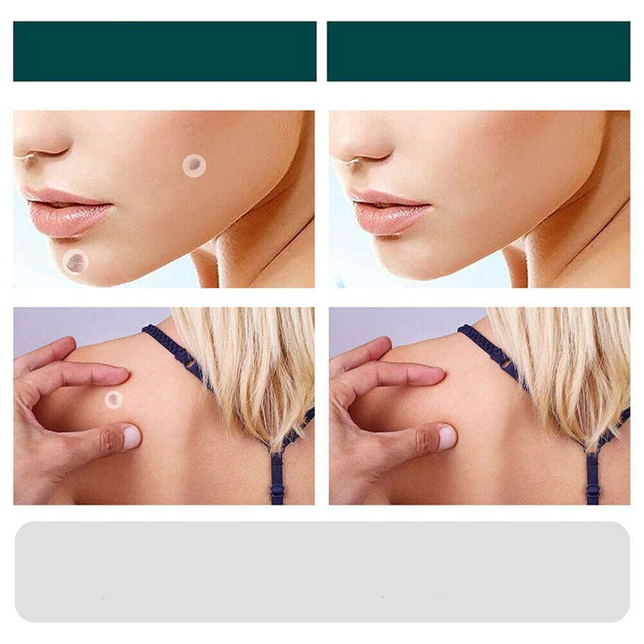 SkinClear - Plastry do usuwania plam i brodawek Karnz