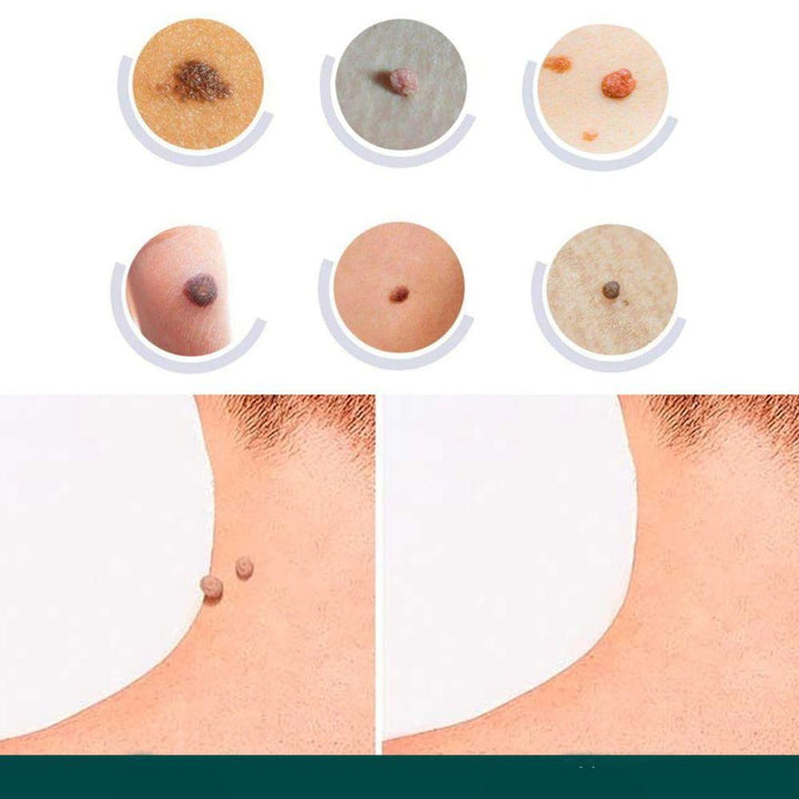SkinClear - Plastry do usuwania plam i brodawek Karnz