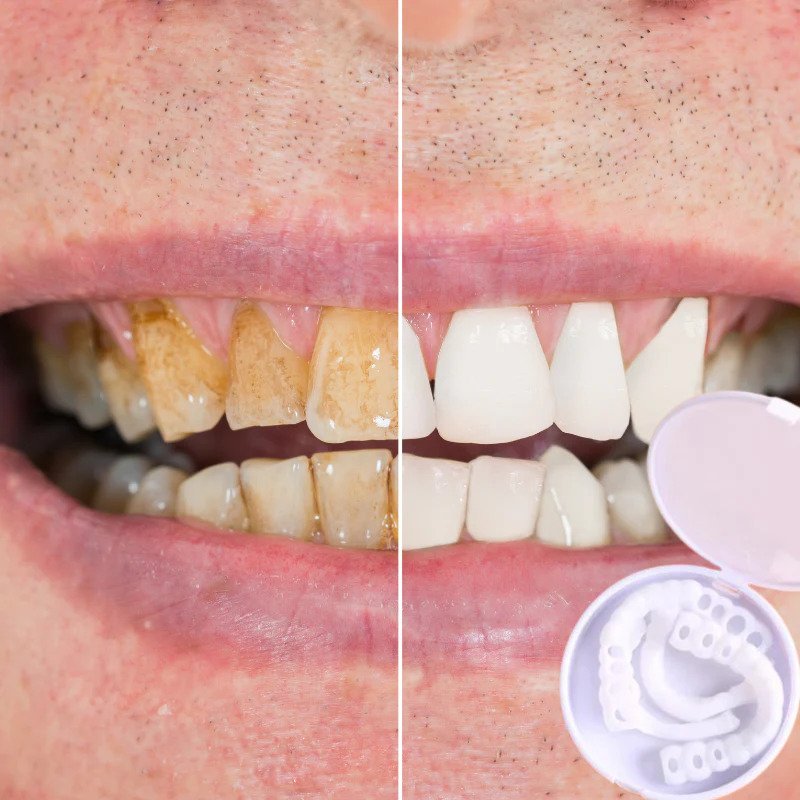 Snap-on Teeth™ – Z tymi licówkami zawsze będziesz mieć idealny uśmiech.